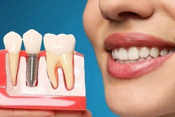 İmplant SSK kapsamına mı